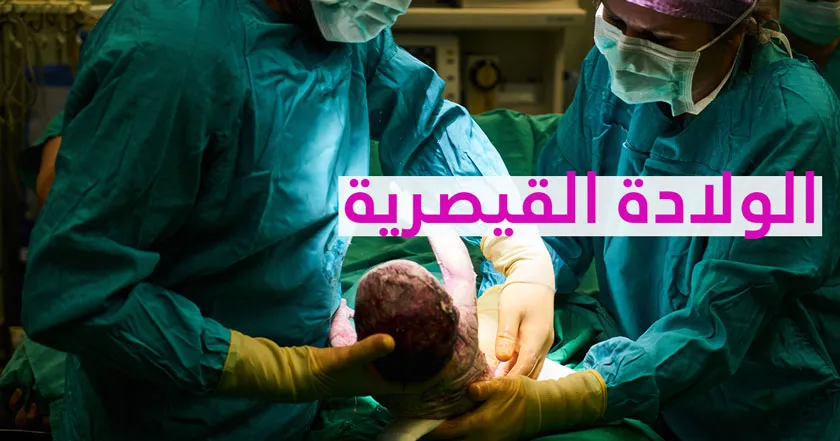 الولادة القيصرية 